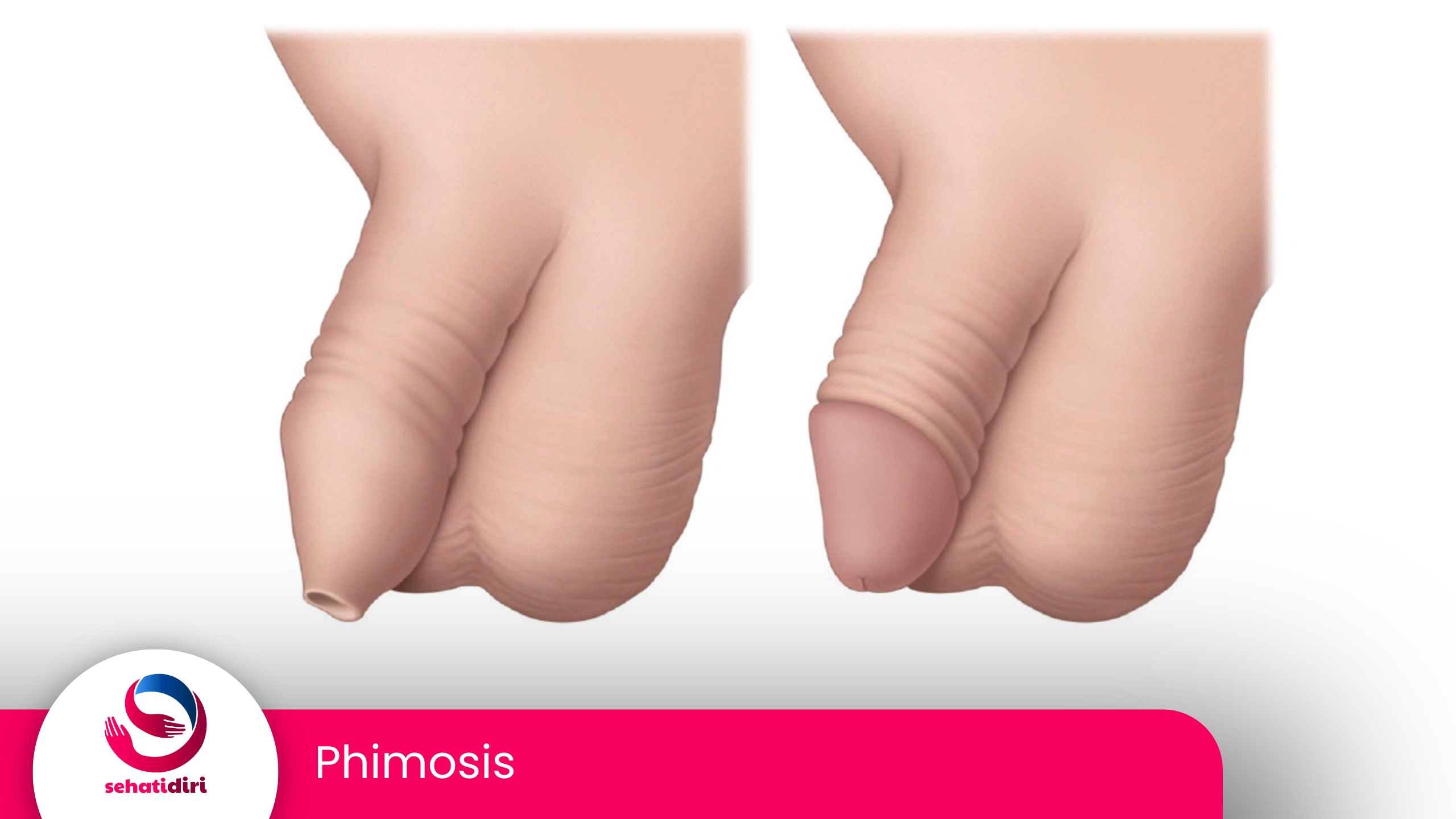 Phimosis