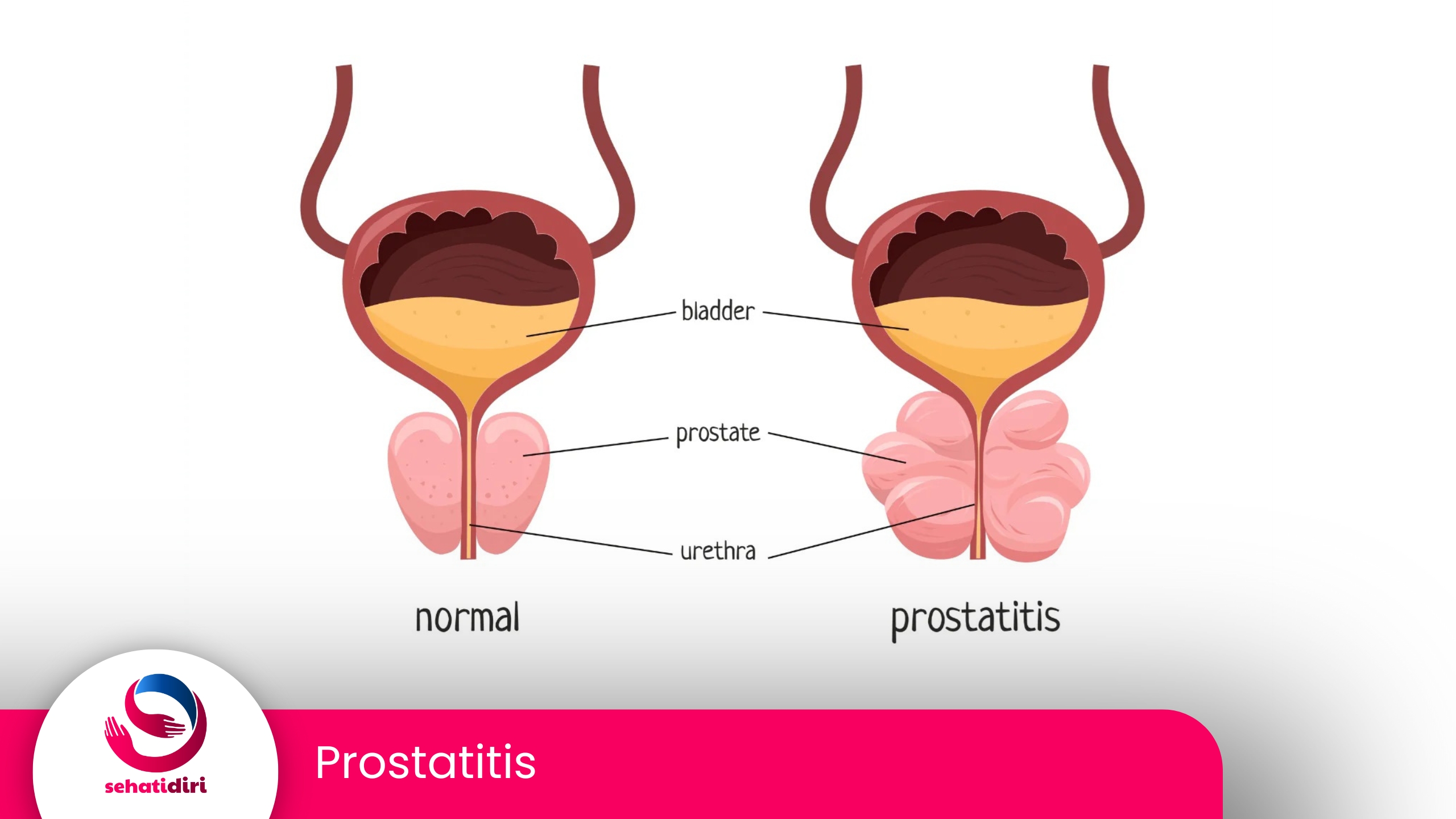 Prostatitis