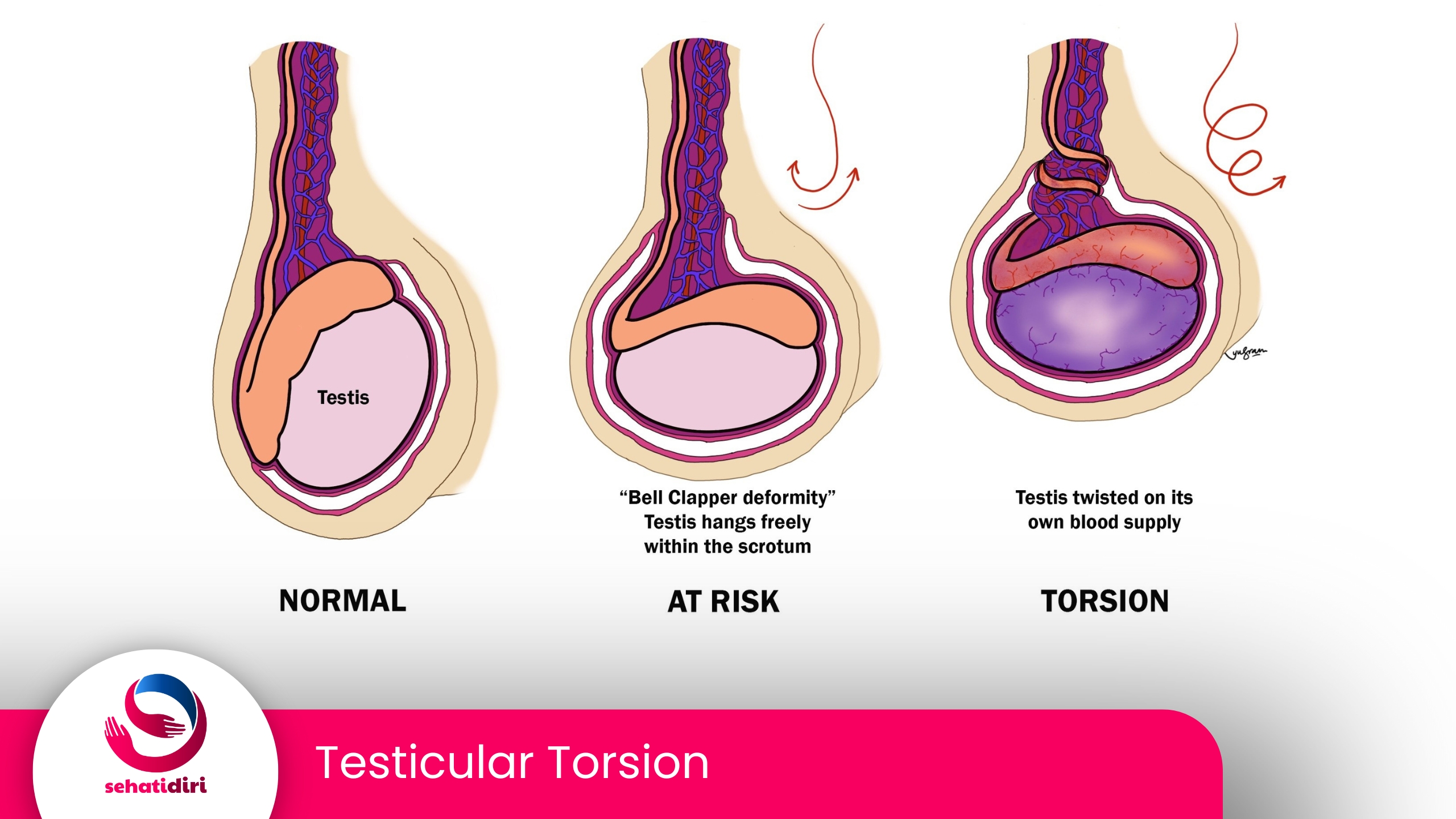 Torsio Testis