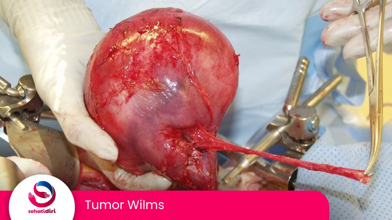 Tumor Wilms