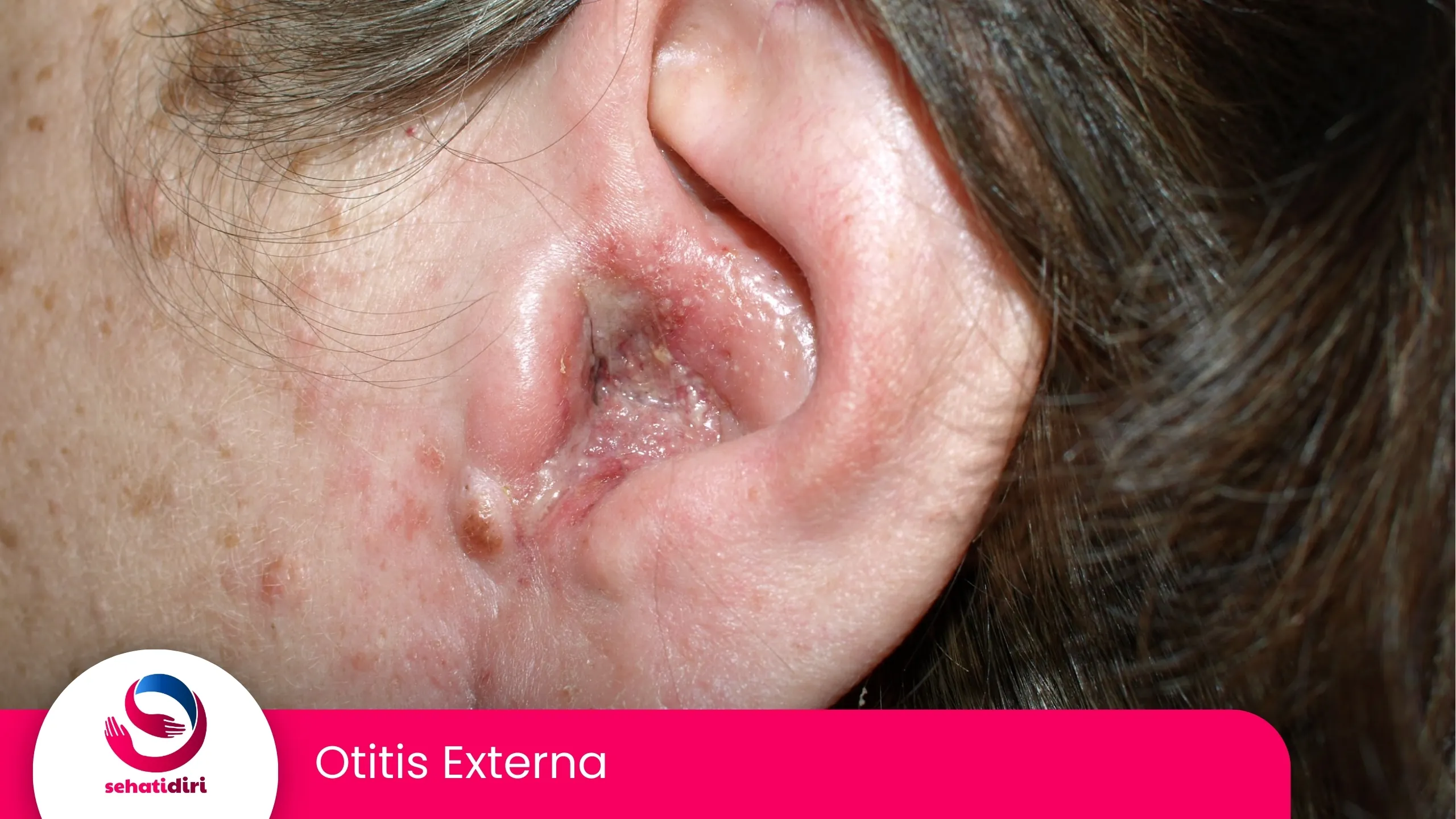 Otitis Externa